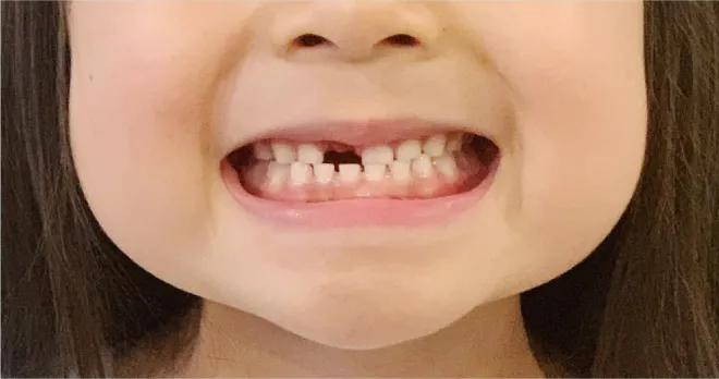 お口の写真をLINEでお送りください(2点)