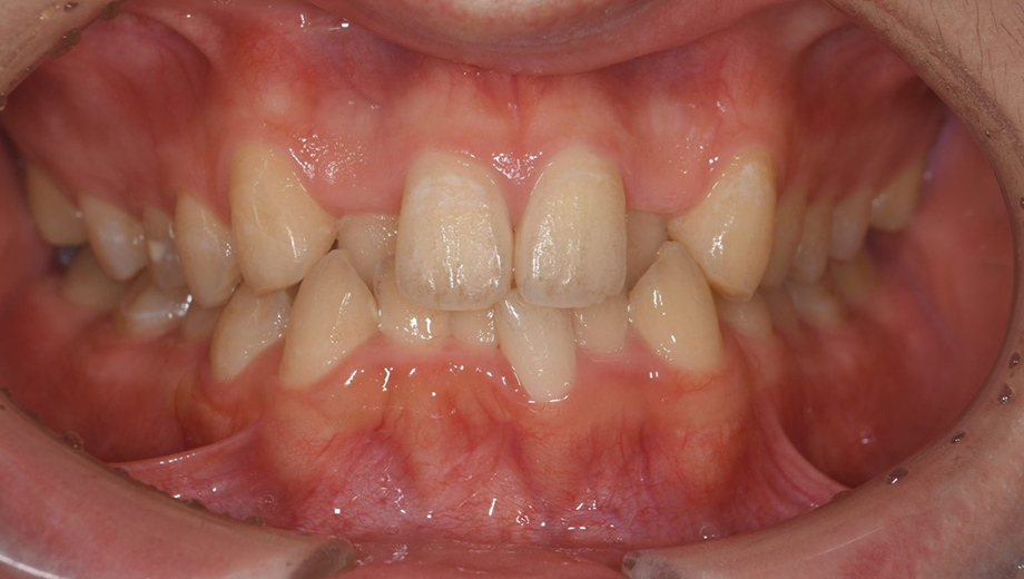 Before