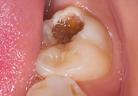 永久歯の虫歯