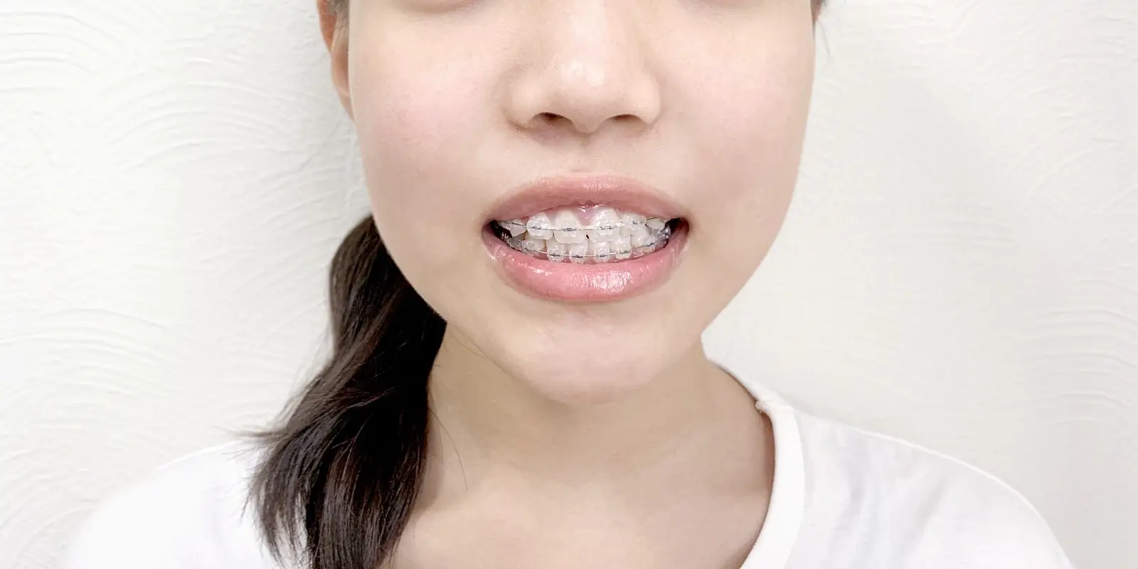 高校生の歯科矯正にかかる費用の相場