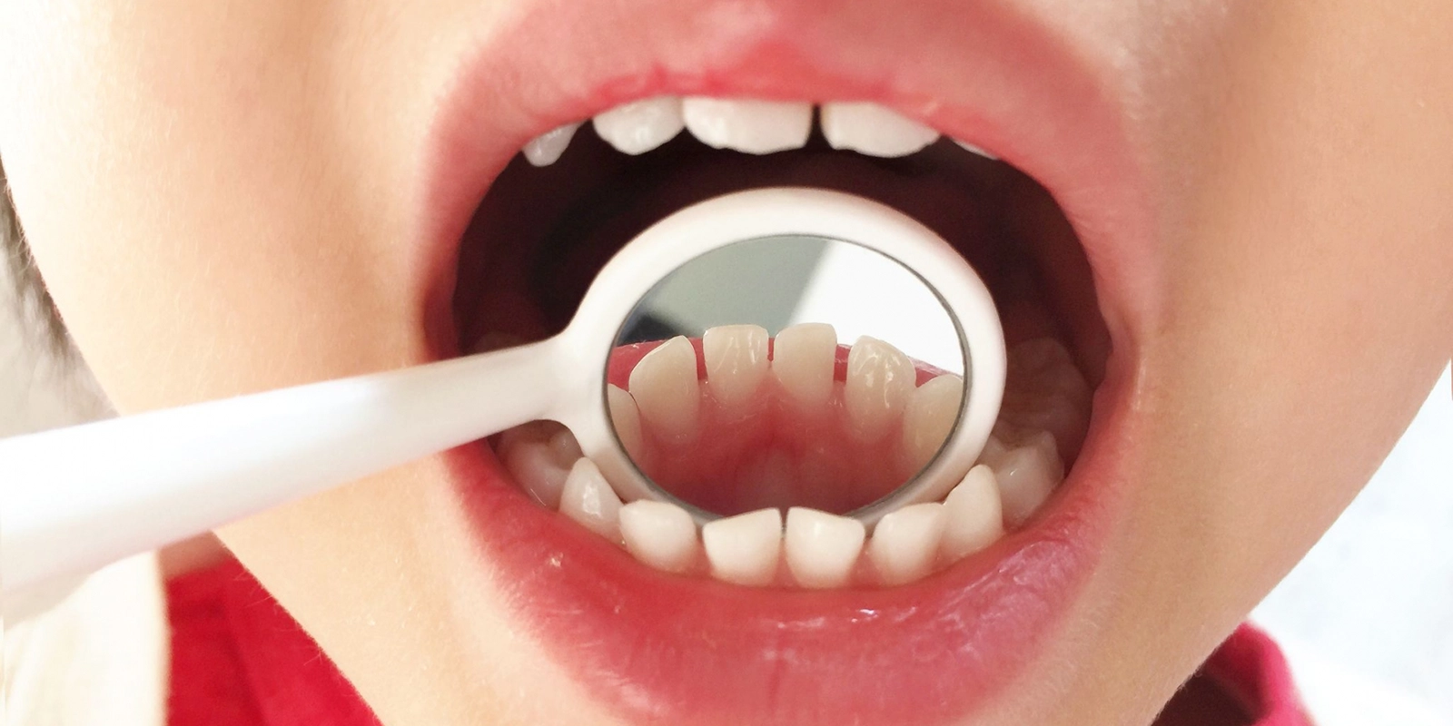 自然に治る可能性が高い子供の歯並び