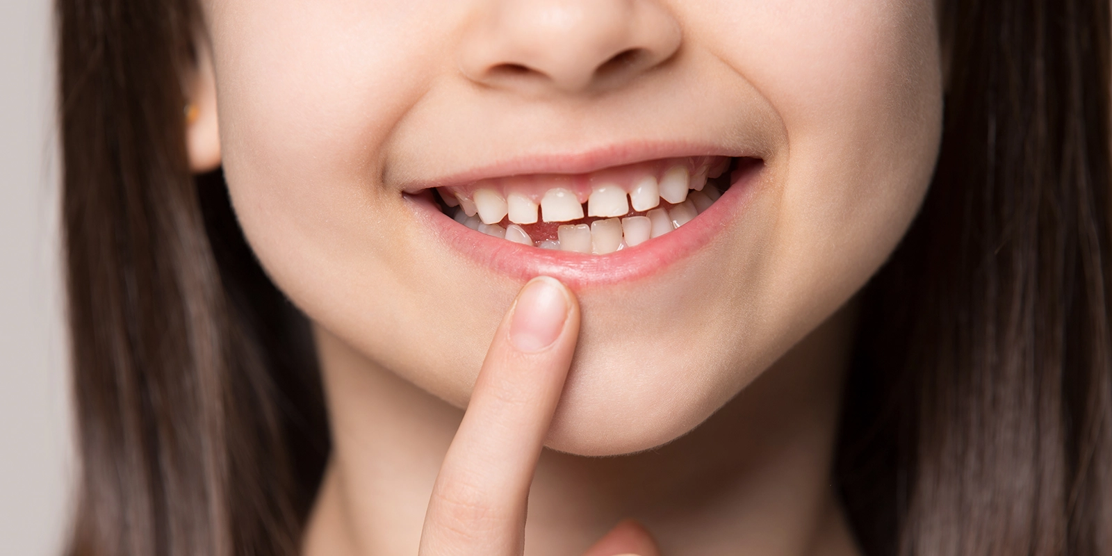 混合歯列期に歯列矯正が必要な歯並び