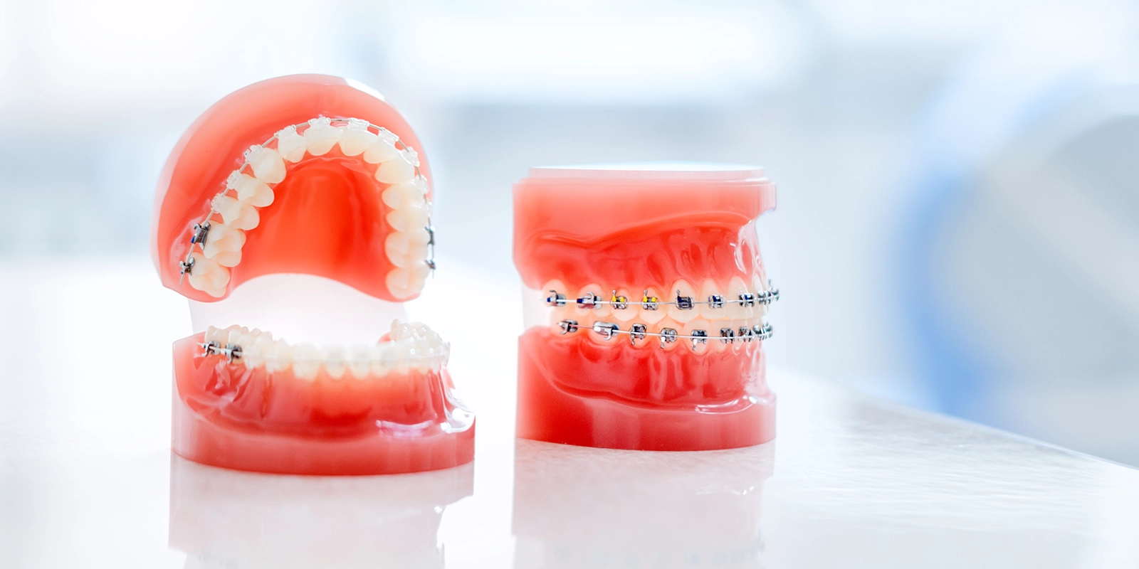 混合歯列期に歯列矯正をするメリット・デメリット